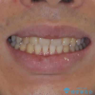 深い咬み合わせと前歯の隙間 ハーフリンガルによる矯正治療の治療後(顔貌)