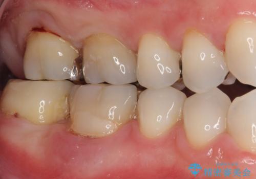 不正咬合で抜歯となった奥歯　インプラントによる咬合回復の症例 治療前