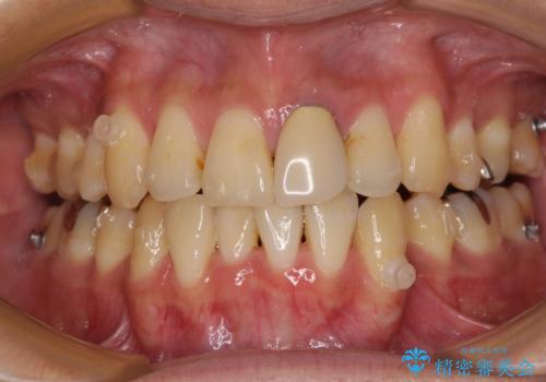 抜歯矯正で八重歯を改善 インビザライン矯正治療の治療中