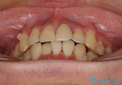 抜歯矯正で八重歯を改善　インビザライン矯正治療の治療中
