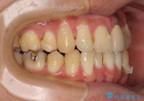 抜歯矯正で八重歯を改善 インビザライン矯正治療の治療中