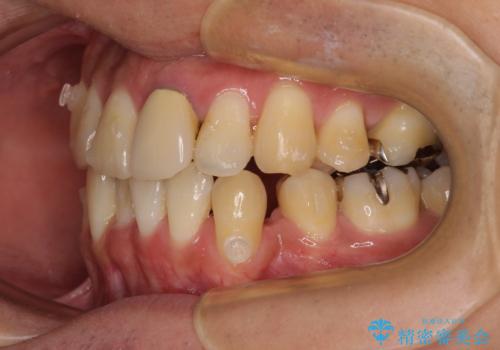 抜歯矯正で八重歯を改善 インビザライン矯正治療の治療中