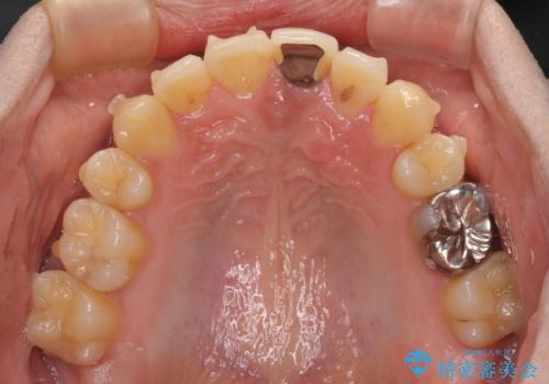 抜歯矯正で八重歯を改善 インビザライン矯正治療の治療中