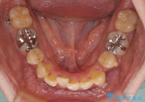 抜歯矯正で八重歯を改善　インビザライン矯正治療の治療中
