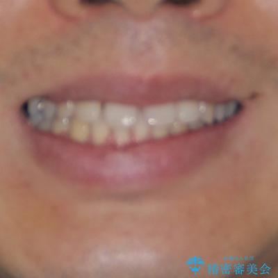 深い咬み合わせと前歯の隙間 ハーフリンガルによる矯正治療の治療前(顔貌)