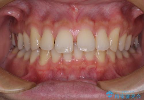 深い咬み合わせと前歯の隙間　ハーフリンガルによる矯正治療の症例 治療前