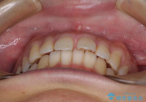 深い咬み合わせと前歯の隙間 ハーフリンガルによる矯正治療の治療前