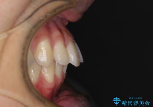 深い咬み合わせと前歯の隙間 ハーフリンガルによる矯正治療の治療前