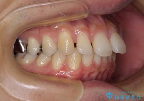 深い咬み合わせと前歯の隙間 ハーフリンガルによる矯正治療の治療前