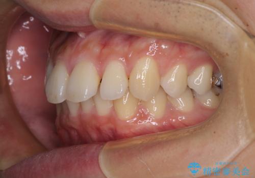 深い咬み合わせと前歯の隙間 ハーフリンガルによる矯正治療の治療前