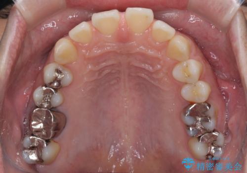 深い咬み合わせと前歯の隙間 ハーフリンガルによる矯正治療の治療前