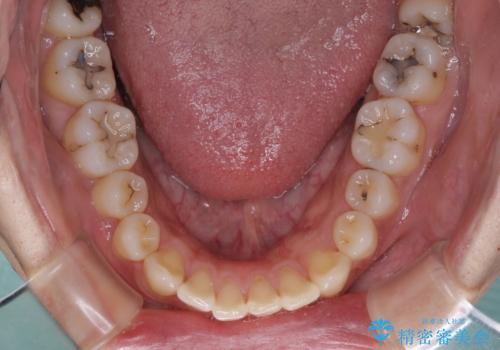 深い咬み合わせと前歯の隙間　ハーフリンガルによる矯正治療の治療前