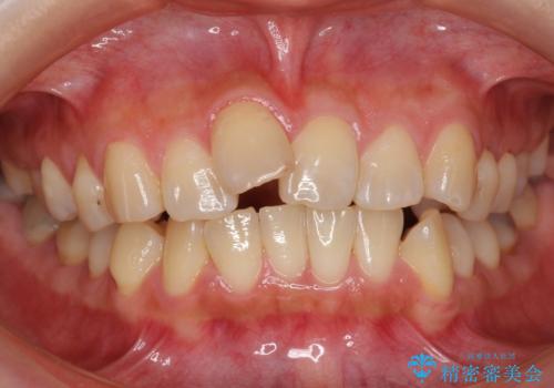 前歯を引っ込めたい 歯を抜かずにマウスピースでの治療前