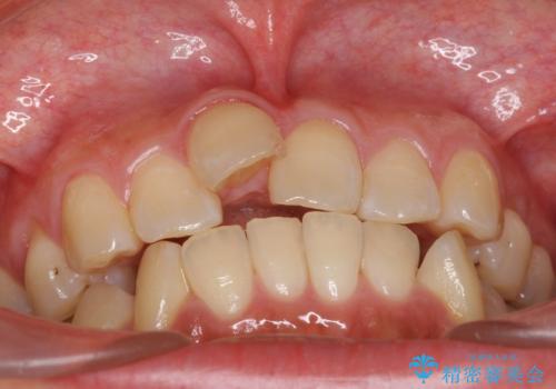 前歯を引っ込めたい 歯を抜かずにマウスピースでの治療前