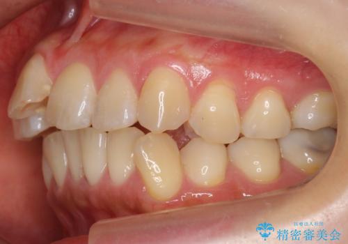 前歯を引っ込めたい 歯を抜かずにマウスピースでの治療前