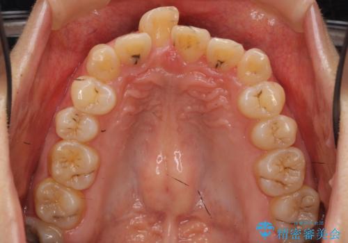 前歯を引っ込めたい 歯を抜かずにマウスピースでの治療前