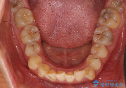 前歯を引っ込めたい 歯を抜かずにマウスピースでの治療前