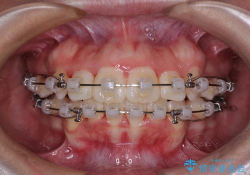 唇からはみ出るほど飛び出した前歯 ワイヤー装置による抜歯矯正の治療中