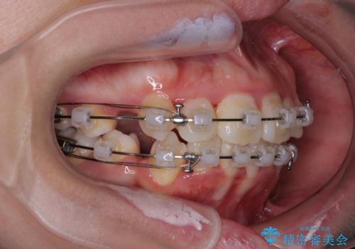 唇からはみ出るほど飛び出した前歯　ワイヤー装置による抜歯矯正の治療中