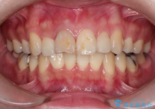 器具が破折して残ったままの前歯の治療前