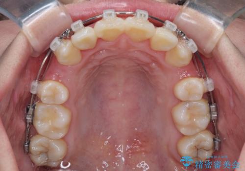唇からはみ出るほど飛び出した前歯 ワイヤー装置による抜歯矯正の治療中