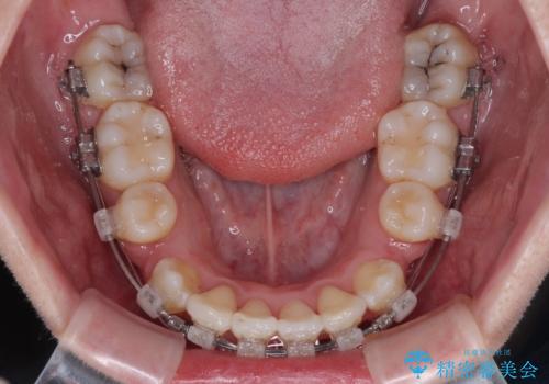 唇からはみ出るほど飛び出した前歯 ワイヤー装置による抜歯矯正の治療中