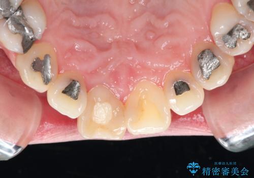 器具が破折して残ったままの前歯の治療前