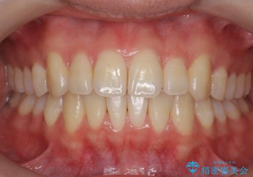 インビザライン　モニター治療　前歯のねじれをまっすぐに　の症例 治療後