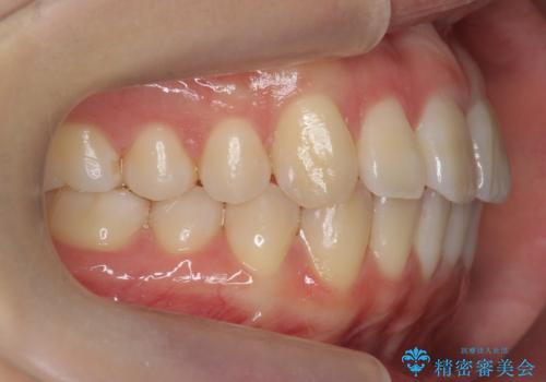 インビザライン　モニター治療　前歯のねじれをまっすぐに　の治療後