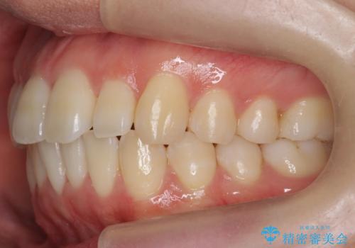インビザライン モニター治療 前歯のねじれをまっすぐに の治療後