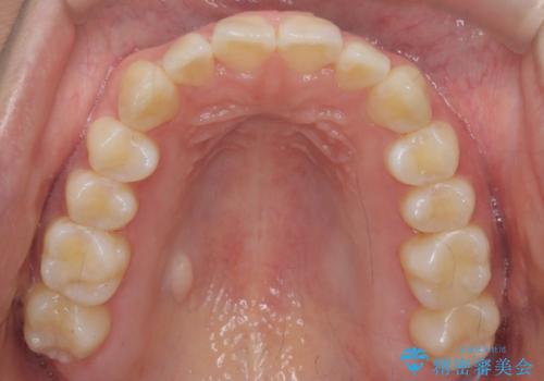 インビザライン モニター治療 前歯のねじれをまっすぐに の治療後