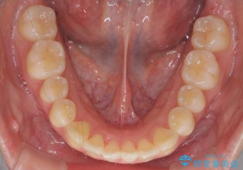 インビザライン　モニター治療　前歯のねじれをまっすぐに　の治療後