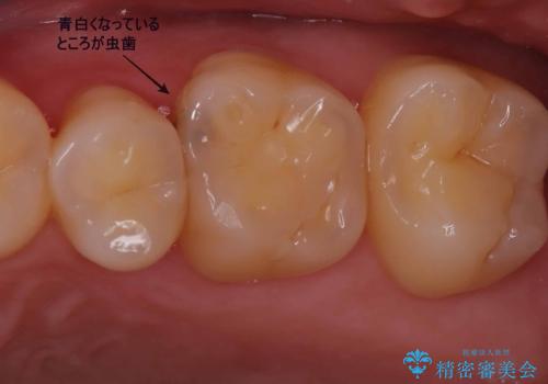 【ハイブリッドインレー】定期検診で見つかった虫歯!の症例 治療前