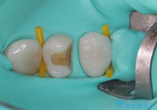 目立つ銀歯と露出した歯根　セラミックでの審美歯科治療の治療中