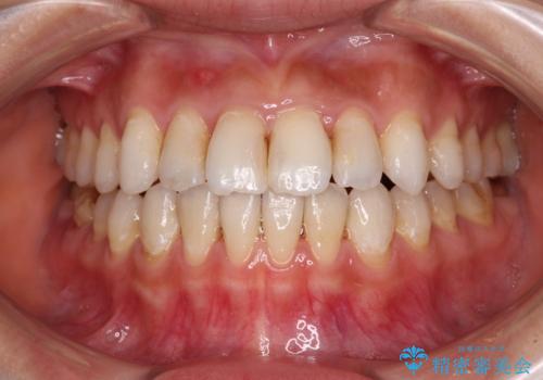 【モニター】開咬を治したい インビザラインによる矯正治療の治療中