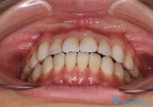 【モニター】開咬を治したい インビザラインによる矯正治療の治療中