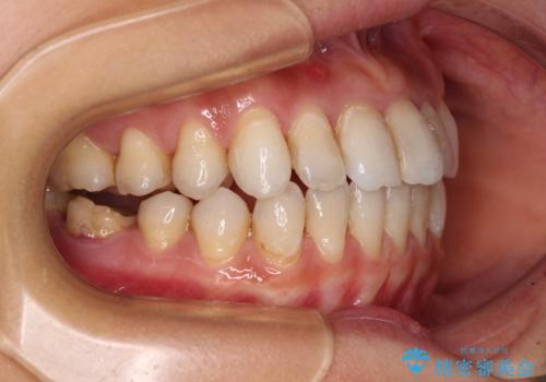 【モニター】開咬を治したい インビザラインによる矯正治療の治療中