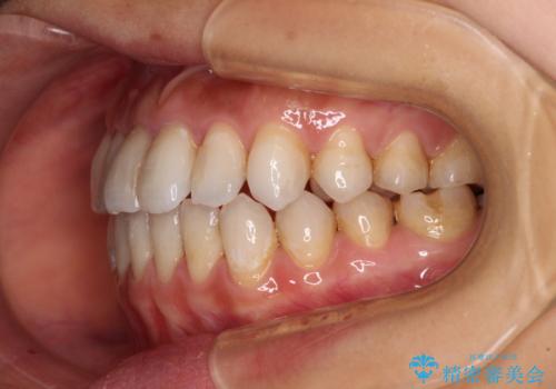 【モニター】開咬を治したい インビザラインによる矯正治療の治療中