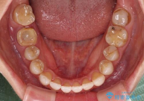 【モニター】開咬を治したい インビザラインによる矯正治療の治療中