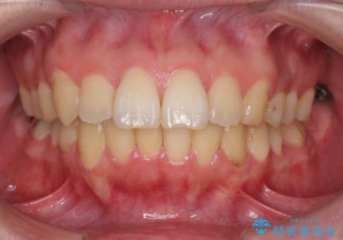 歯を抜かずに行う前歯の角度の改善の症例 治療後