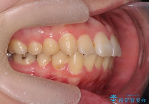 歯を抜かずに行う前歯の角度の改善