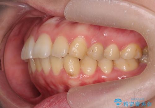 歯を抜かずに行う前歯の角度の改善の治療後