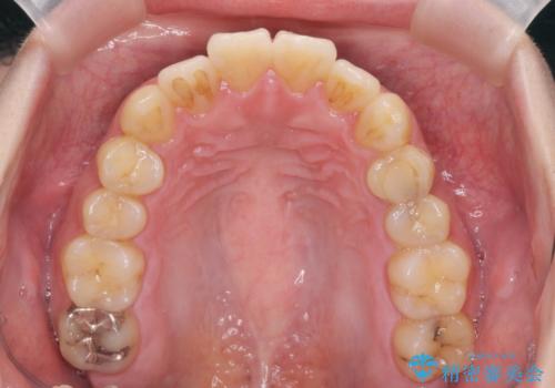 歯を抜かずに行う前歯の角度の改善の治療後