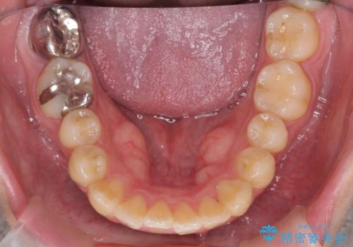 歯を抜かずに行う前歯の角度の改善の治療後