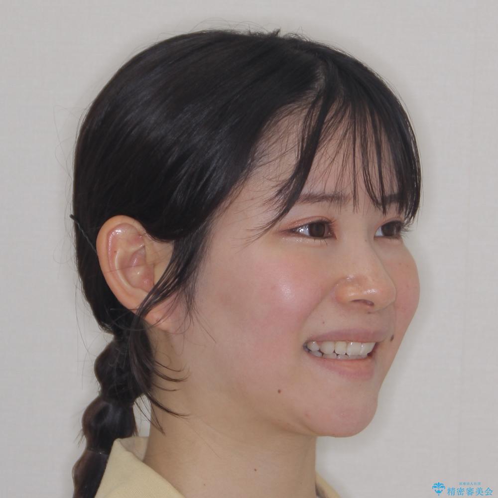 【モニター】口が閉じにくい 膨らんだ口元を抜歯矯正ですっきりとの治療後(顔貌)