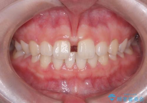 【上唇小帯切除術】子どもの頃から上の前歯の歯茎が気になってた!の治療前