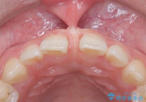 【上唇小帯切除術】子どもの頃から上の前歯の歯茎が気になってた!の治療前