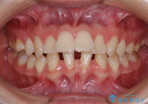 前歯が2本ない　ワイヤー装置での抜歯矯正の症例 治療前