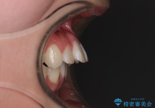 前歯が2本ない　ワイヤー装置での抜歯矯正の治療前