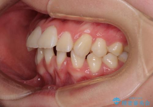 前歯が2本ない　ワイヤー装置での抜歯矯正の治療前